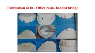 Fabrication of In - Office resin- bonded bridge
 