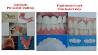 Removable
Provisional Prosthesis
Fixed prosthesis and
Resin bonded ridge
 