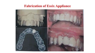 Fabrication of Essix Appliance
 