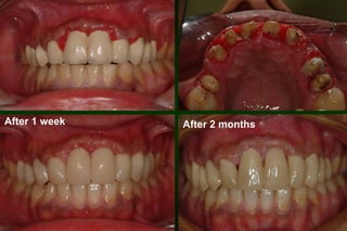 After 1 week

After 2 months

 