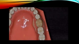 Provisional restoration