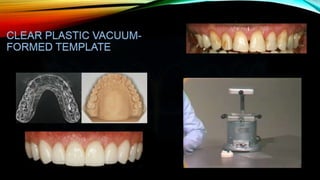 Provisional restoration