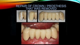 Provisional restoration