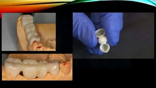 Provisional restoration