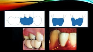 Provisional restoration