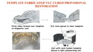 TEMPLATE FABRICATED VLC CURED PROVISIONAL
RESTORATION
 