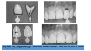 Maya zalkind, DMD," and nira hochman, DDS , laminate veneer provisional restorations: A clinical report, The Journal of Prosthetic
Dentistry, February, Volume 77 Number2 1997,
 