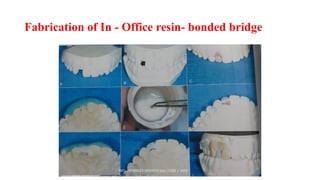 Fabrication of In - Office resin- bonded bridge
 