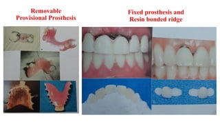Removable
Provisional Prosthesis
Fixed prosthesis and
Resin bonded ridge
 