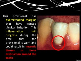This provisional has
overextended margins
that have caused
gingival irritation. This
inflammation will
progress during the
time that the
provisional is worn and
could result in necrotic
tissues or bone
destruction around the
tooth
 