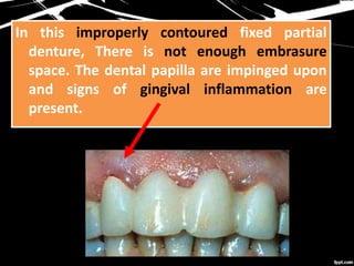 In this improperly contoured fixed partial
denture, There is not enough embrasure
space. The dental papilla are impinged upon
and signs of gingival inflammation are
present.
 