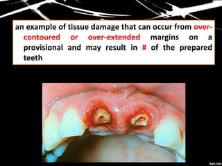 an example of tissue damage that can occur from over-
contoured or over-extended margins on a
provisional and may result in # of the prepared
teeth
 