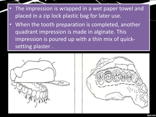 • The impression is wrapped in a wet paper towel and
placed in a zip lock plastic bag for later use.
• When the tooth preparation is completed, another
quadrant impression is made in alginate. This
impression is poured up with a thin mix of quick-
setting plaster .
 