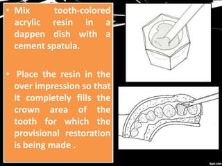 • Mix tooth-colored
acrylic resin in a
dappen dish with a
cement spatula.
• Place the resin in the
over impression so that
it completely fills the
crown area of the
tooth for which the
provisional restoration
is being made .
 