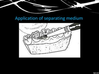 Application of separating medium
 