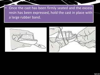 • Once the cast has been firmly seated and the excess
resin has been expressed, hold the cast in place with
a large rubber band.
 