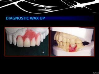 DIAGNOSTIC WAX UP
 