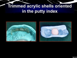Trimmed acrylic shells oriented
in the putty index
 
