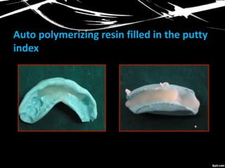 Auto polymerizing resin filled in the putty
index
 