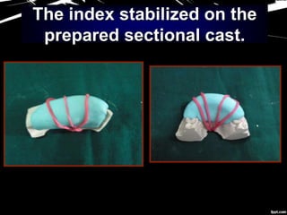 The index stabilized on the
prepared sectional cast.
 