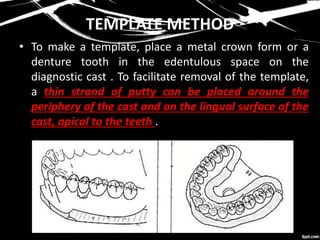 TEMPLATE METHOD
• To make a template, place a metal crown form or a
denture tooth in the edentulous space on the
diagnostic cast . To facilitate removal of the template,
a thin strand of putty can be placed around the
periphery of the cast and on the lingual surface of the
cast, apical to the teeth .
 