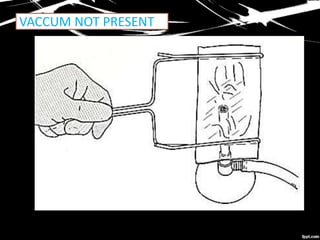 VACCUM NOT PRESENT
 