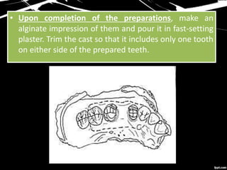 • Upon completion of the preparations, make an
alginate impression of them and pour it in fast-setting
plaster. Trim the cast so that it includes only one tooth
on either side of the prepared teeth.
 