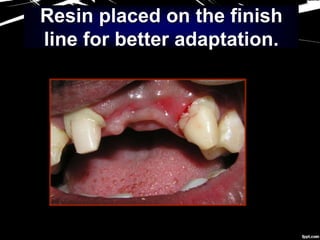 Resin placed on the finish
line for better adaptation.
 