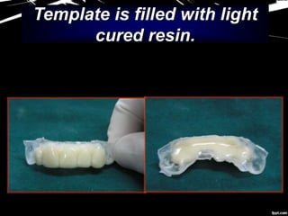 Template is filled with light
cured resin.
 