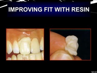 IMPROVING FIT WITH RESIN
 