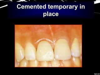 Cemented temporary in
place
 