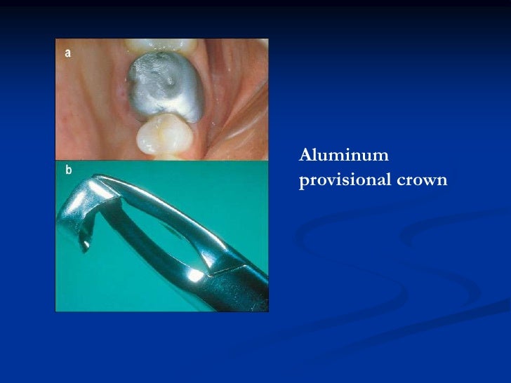 Provisional restorations