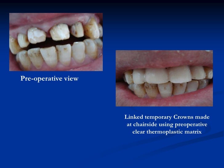 Provisional restorations