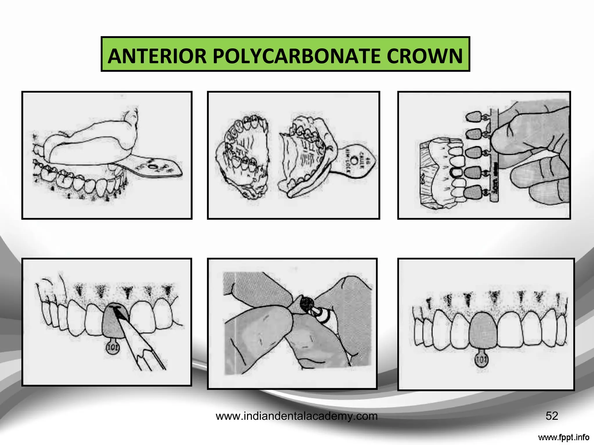 ProPrietary Plastic shells
• Proximal excess is removed
• Crown removed and replaced several times to prevent
resin setting in undercuts
• Crown is adjusted and polished using steel or tungsten
carbide burs and Soflex discs.
52www.indiandentalacademy.com
 