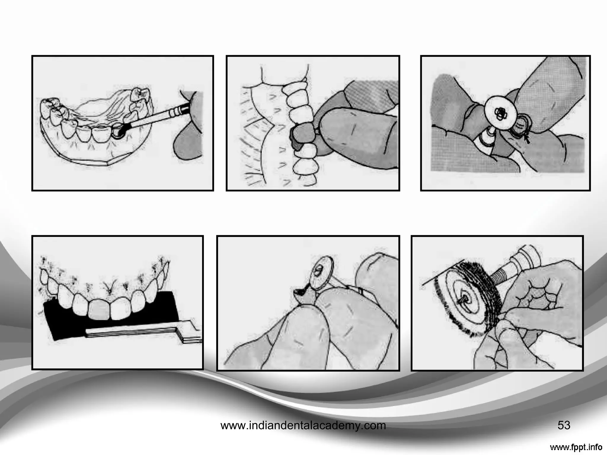 ANTERIOR POLYCARBONATE CROWN
53www.indiandentalacademy.com
 