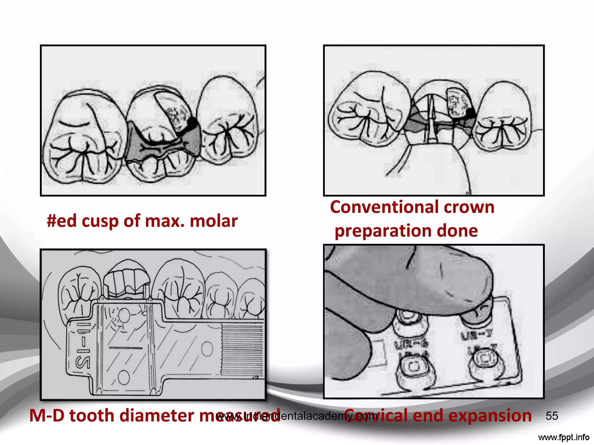 ProPrietary metal shells
• Aluminium crowns ----
 Only suitable for short-term use as they are soft resulting
in wear and deformation
 Can produce galvanic reactions in association with
amalgam restorations.
 Fit is usually poor unless considerable time is spent
trimming and crimping the margins followed by relining
with a resin
• Stainless steel or nickel chromium crowns
 May occasionally be used on molar teeth opposed by flat
cusps where heavy occlusal loading would quickly wear
or break a resin crown.
55www.indiandentalacademy.com
 