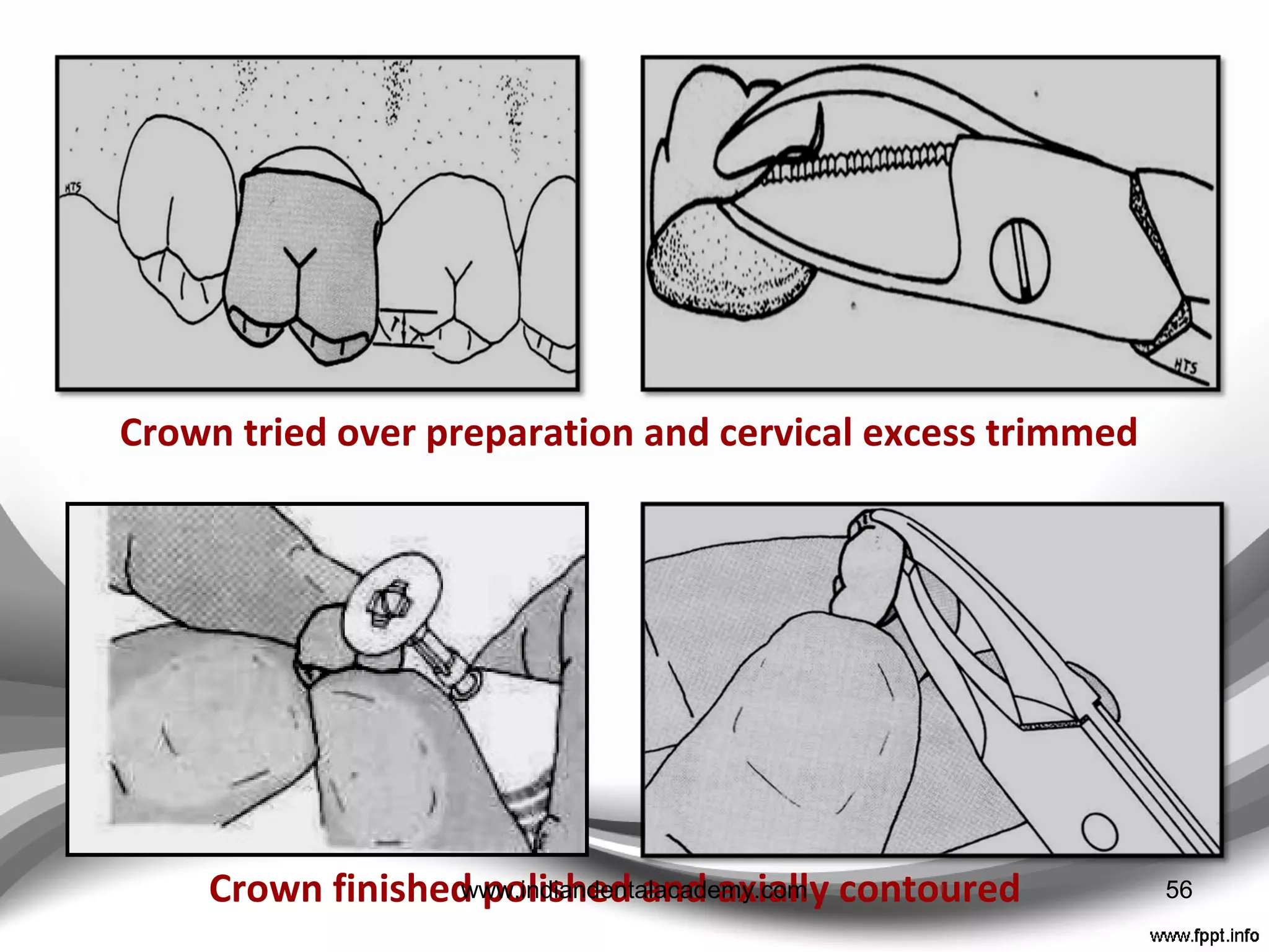 #ed cusp of max. molar
Conventional crown
preparation done
M-D tooth diameter measured Cervical end expansion 56www.indiandentalacademy.com
 