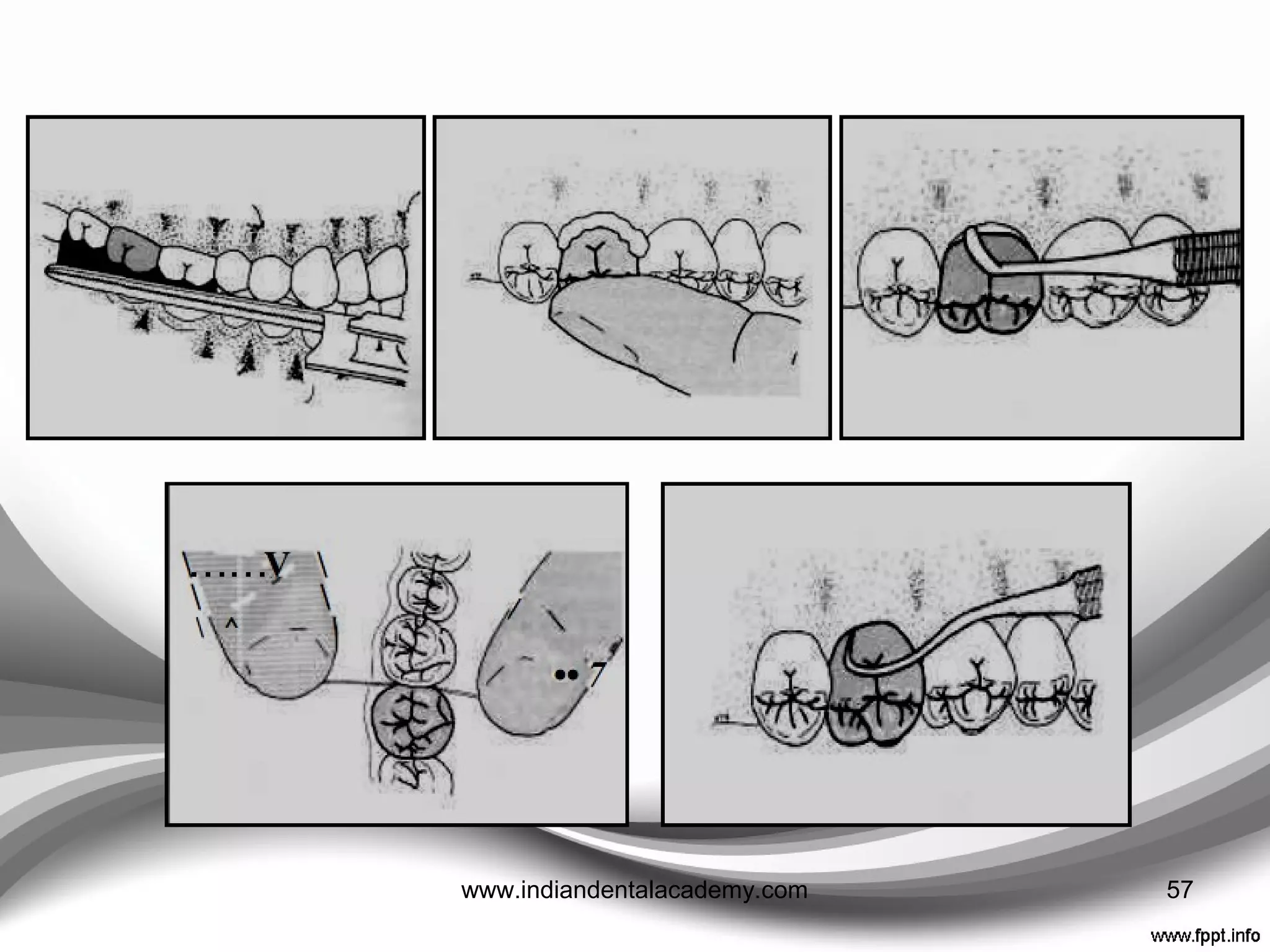 Crown tried over preparation and cervical excess trimmed
Crown finished polished and axially contoured 57www.indiandentalacademy.com
 