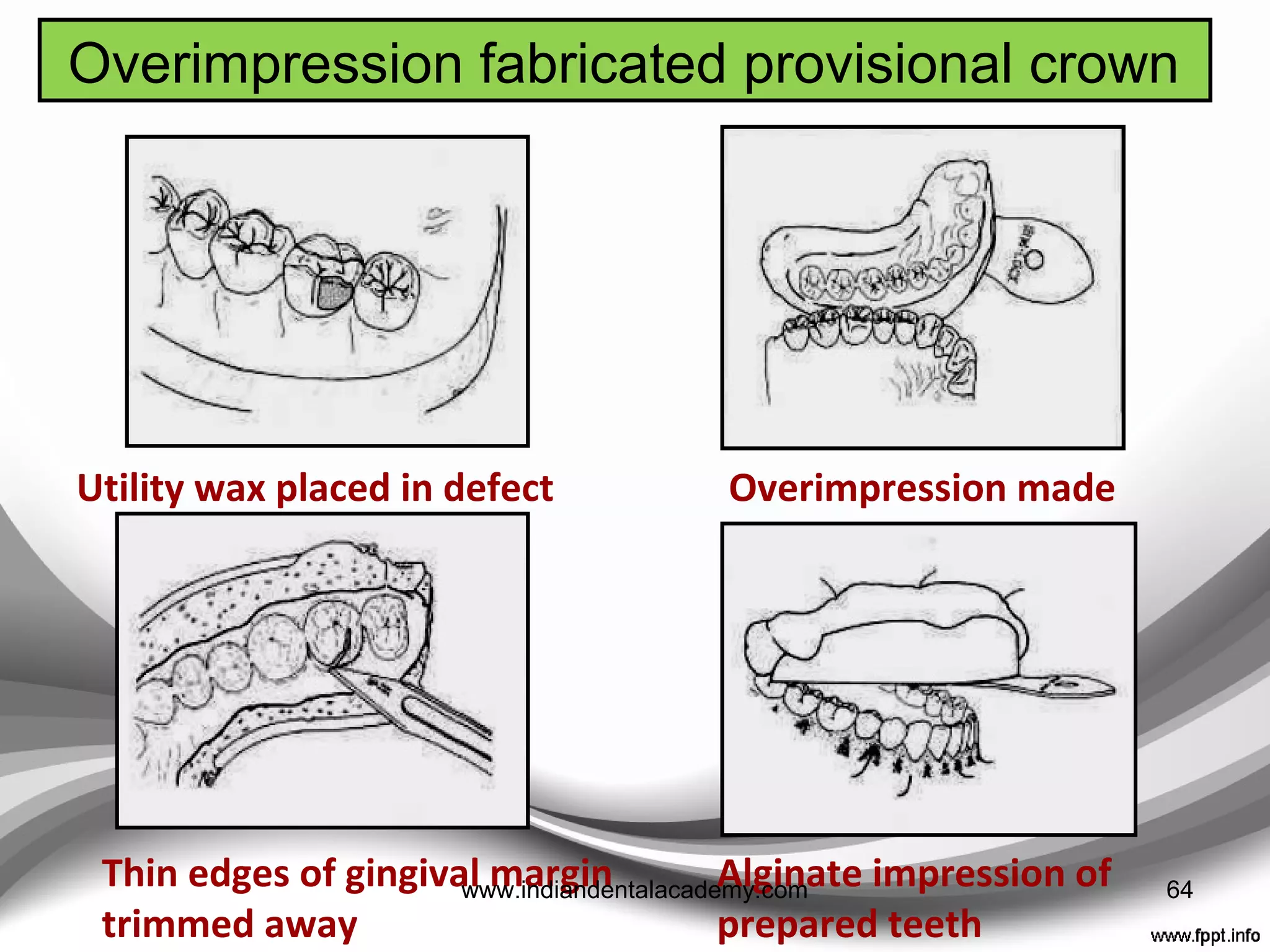 imPression matrices
ALGINATE
• Best at absorbing the
resin exotherm
ELASTOMER
• Reusable,
• Can be stored in case they are
required again.
• Ease of handling
• long-term stability.
• Flexible
• Good flow
• Affinity, Aquasil, TempSpan
clear matrix, Star VPS clearbite
• QUICK, EASY AND INEXPENSIVE,
• DIRECT OR INDIRECT
Int J Prosthodont 1990;3:
299-304.
64www.indiandentalacademy.com
 