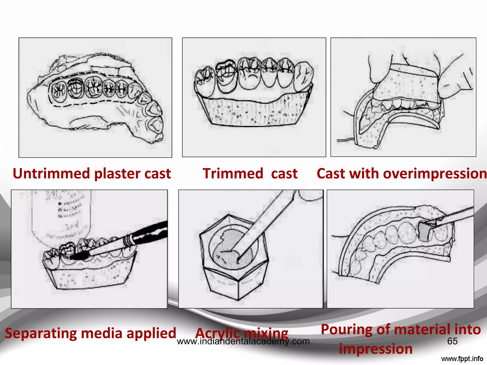 Utility wax placed in defect Overimpression made
Thin edges of gingival margin
trimmed away
Alginate impression of
prepared teeth
Overimpression fabricated provisional crown
65www.indiandentalacademy.com
 