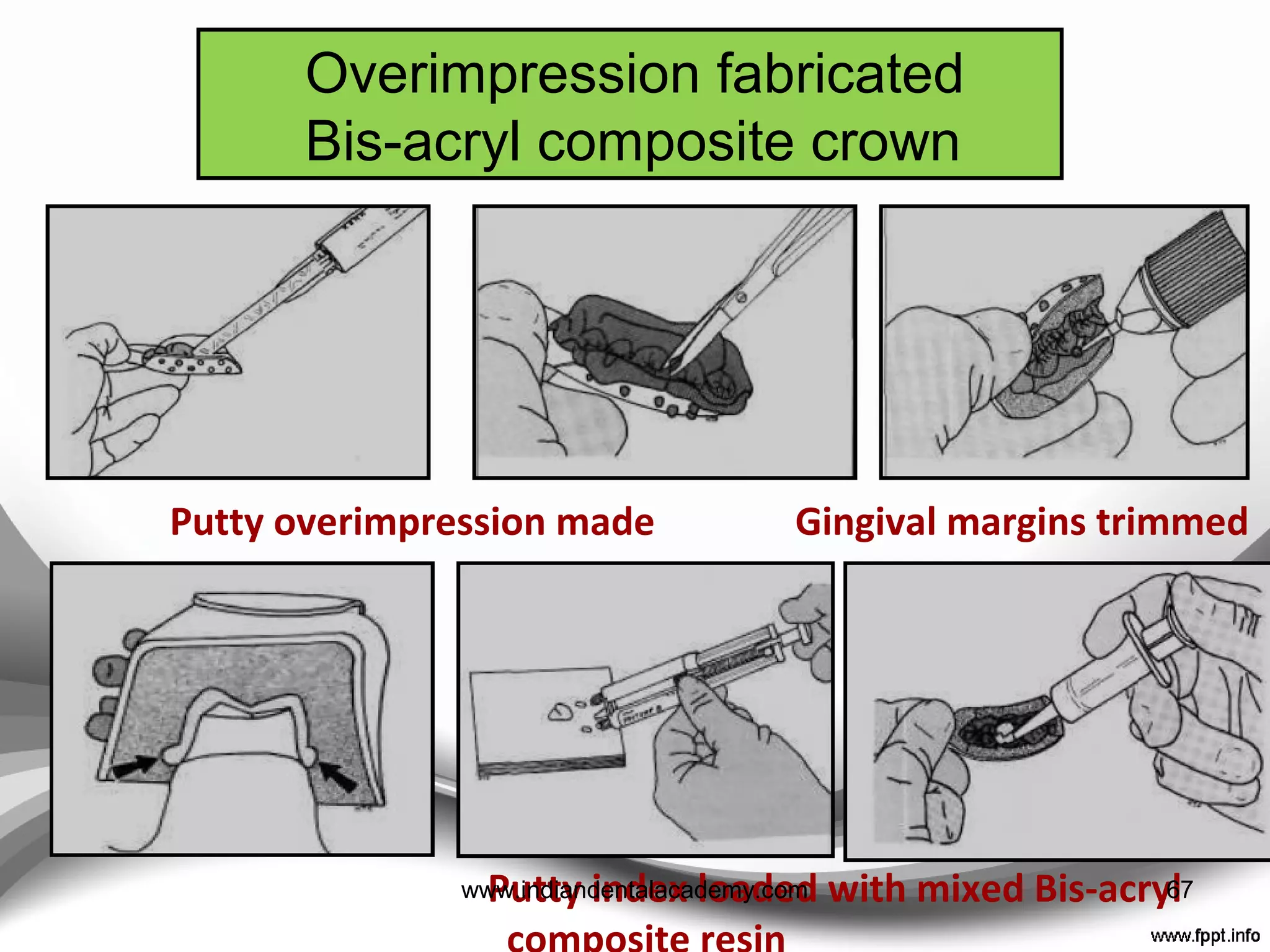 Plaster cast secured
with impression
Crown removed from
cast cast
Plaster removed from
inside
Extra resin removed and smoothened with
sand paper disc
Intraoral occlusal
adjustment done
67www.indiandentalacademy.com
 