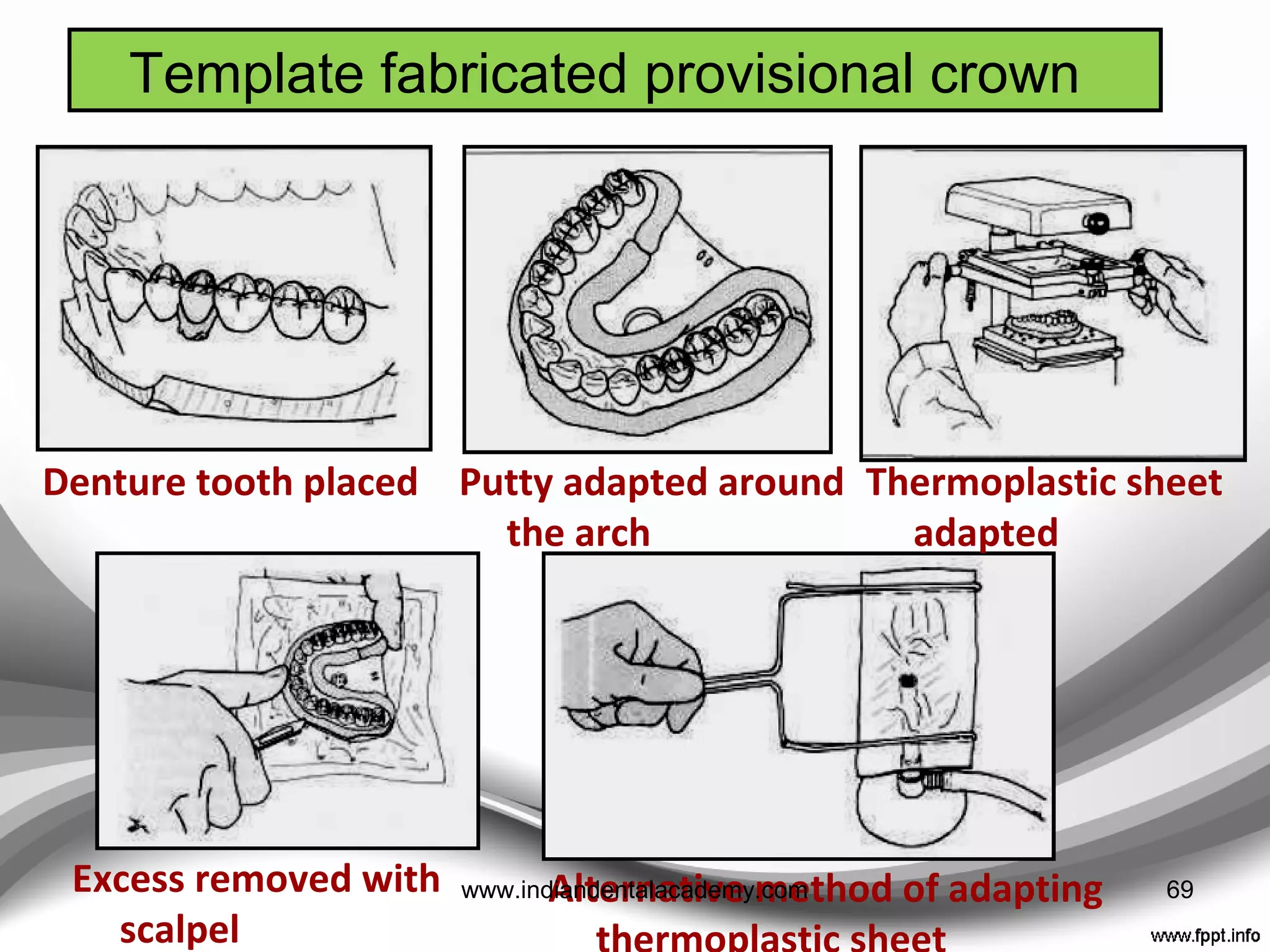 Vacuum formed matrices
• Made of clear vinyl sheet produced on a stone duplicate
of the waxed up cast.
• Flexible and can distort when seated, especially if there
are few or no adjacent teeth to aid location
• Indispensable for moulding light cured resins.
69www.indiandentalacademy.com
 