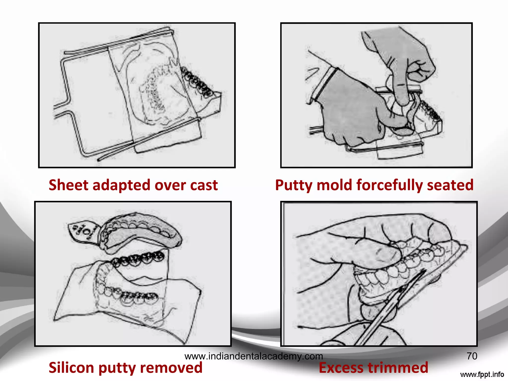 Template fabricated provisional crown
Denture tooth placed Putty adapted around
the arch
Thermoplastic sheet
adapted
Excess removed with
scalpel
Alternative method of adapting 70www.indiandentalacademy.com
 