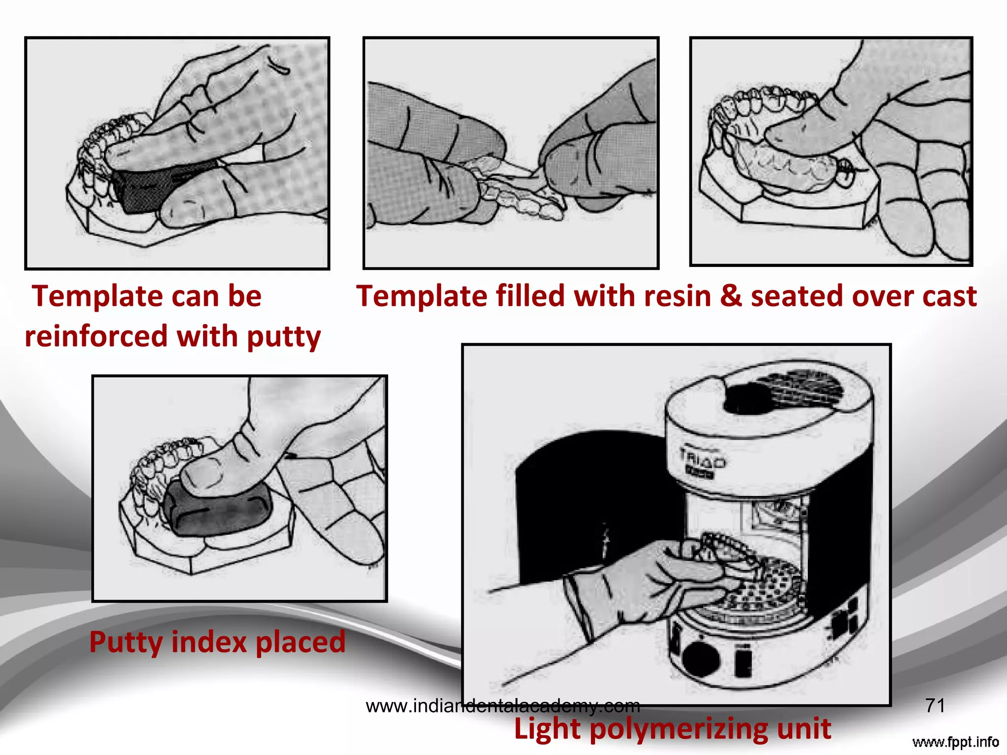 Sheet adapted over cast Putty mold forcefully seated
Silicon putty removed Excess trimmed
71www.indiandentalacademy.com
 