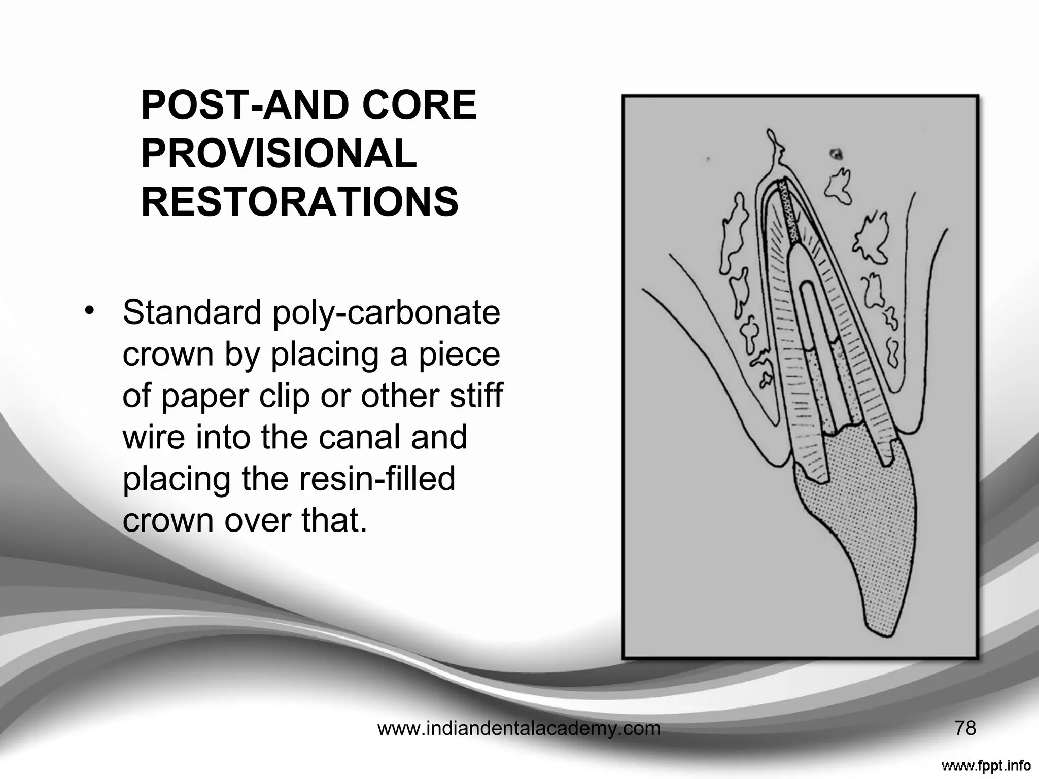 4. Composite resin bonded to the opposing tooth to
maintain occlusal contact and prevent over-eruption
5. Conventional provisional restorations cemented with
either a non-eugenol temporary cement or a hard
cement such as zinc carboxylate.
Effective only in the short -term.
78www.indiandentalacademy.com
 