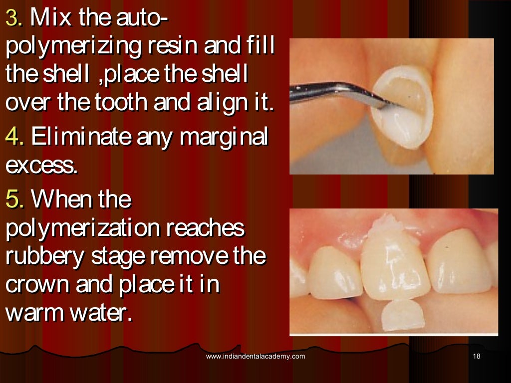 Provisional restorations finalised /certified fixed orthodontic cours…