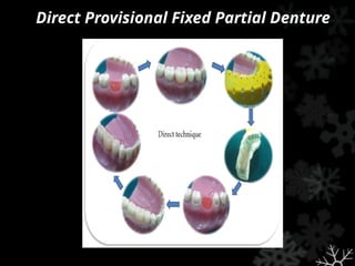 Direct Provisional Fixed Partial Denture
 