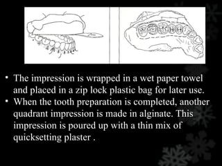 • The impression is wrapped in a wet paper towel
and placed in a zip lock plastic bag for later use.
• When the tooth preparation is completed, another
quadrant impression is made in alginate. This
impression is poured up with a thin mix of
quicksetting plaster .
 