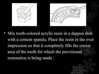 • Mix tooth-colored acrylic resin in a dappen dish
with a cement spatula. Place the resin in the over
impression so that it completely fills the crown
area of the tooth for which the provisional
restoration is being made .
 