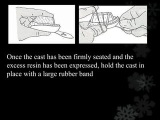Once the cast has been firmly seated and the
excess resin has been expressed, hold the cast in
place with a large rubber band
 
